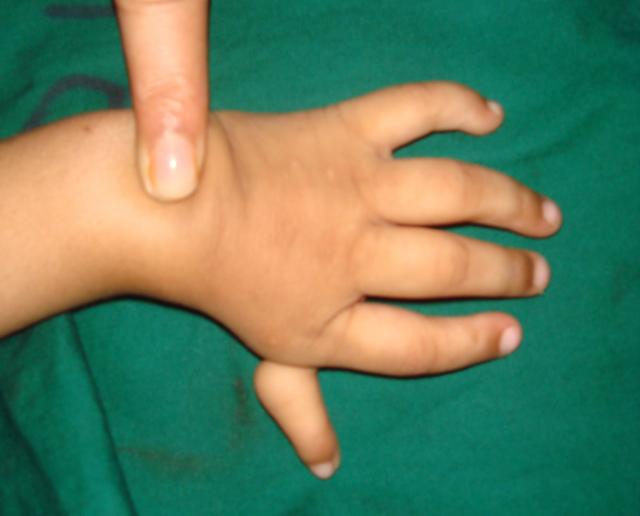 Case -1 Pre operation